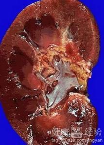 肾积水手术视频,技术要点与术后康复指导